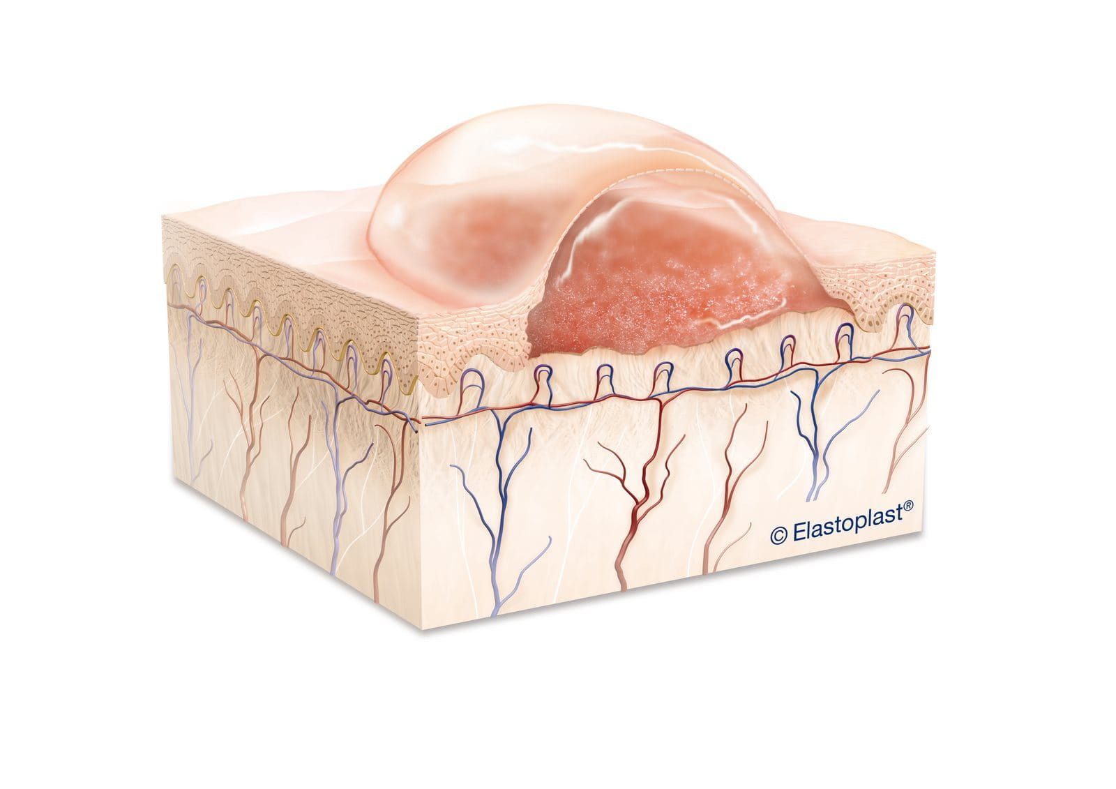 How To Treat A Curling Iron Burn Elastoplast UK